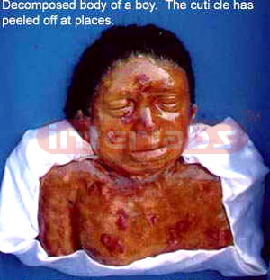 Decomposed body of a boy showing peeled cuticle